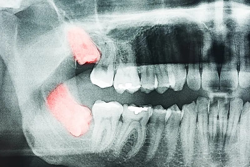Estrazione di un dente del giudizio
